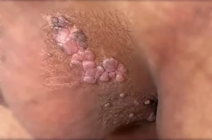 Clinics offering safe genital warts laser Sari