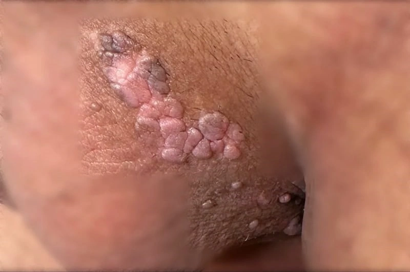 Clinics offering safe genital warts laser Sari